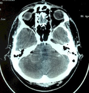 linfoma_cerebral_primario/TAC_edema_cerebral