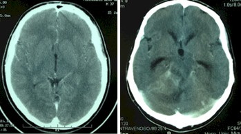 linfoma_cerebral_primario/TAC_tumor_cerebelo