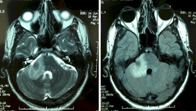 linfoma_cerebral_primario/edema_cerebelo_RMN