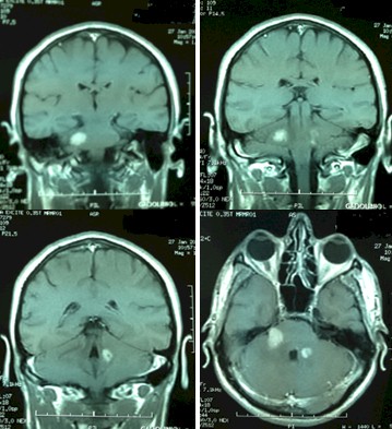 linfoma_cerebral_primario/resonancia_magnetica_cerebral