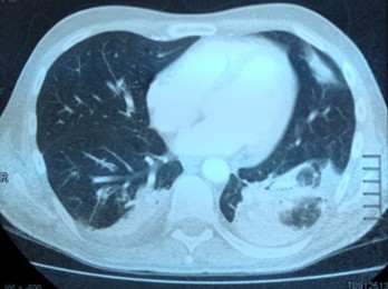 linfoma_cerebral_primario/sepsis_bronconeumonia_derecha